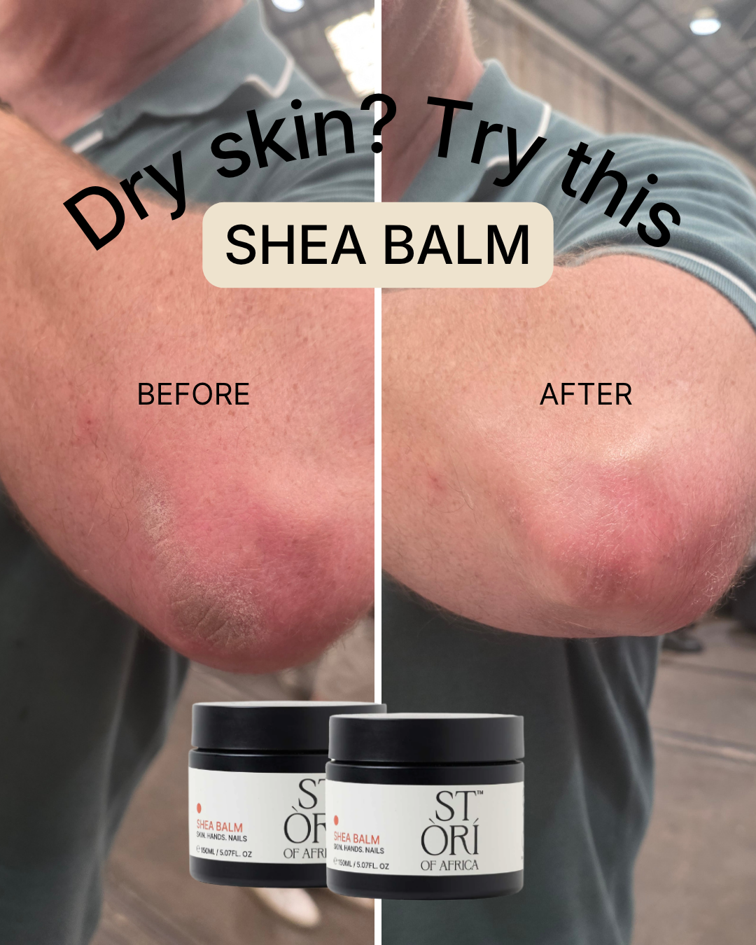 Before and after comparison of dry skin with shea balm application, featuring Stori of Africa Shea Balm